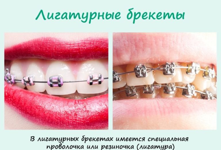 Меню Какие брекеты лучше поставить?